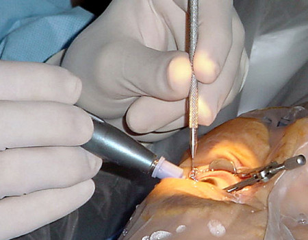 Axa Optic – Chirurgia glaucomului